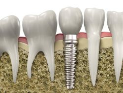 Single Tooth Implants | Single Dental Implant Cost Near Me