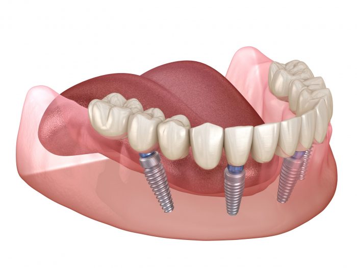 Upper And Lower Dental Implants