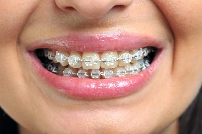 Dental Implants: Before or After Braces