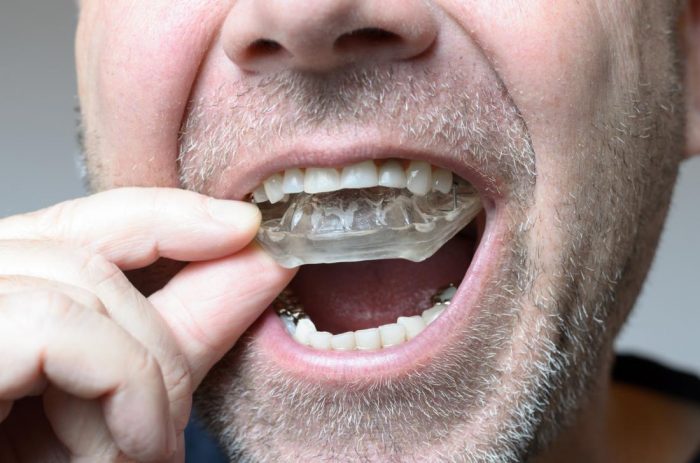 What Do Invisalign Braces Cost? Are They Worth It?