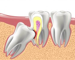 Wisdom Teeth Extraction in Houston, Tx | Low Cost Treatment