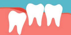 Affordable Wisdom Teeth Removal in Houston