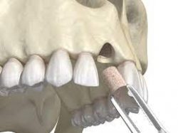 Why Would You Need a Dental Bone Graft