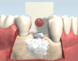 Dental implant surgery |What are dental implants? Types, procedures