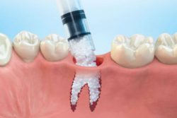 What to Expect From Bone Grafting for Dental Implants |What You Need To Know About A Dental Bone ...