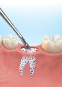 Bone Graft for Dental Implants: Bone Graft For Dental Implants: Understanding The Possibility