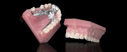 What Is a Removable Partial Denture? – Simply Smiles Dentistry
