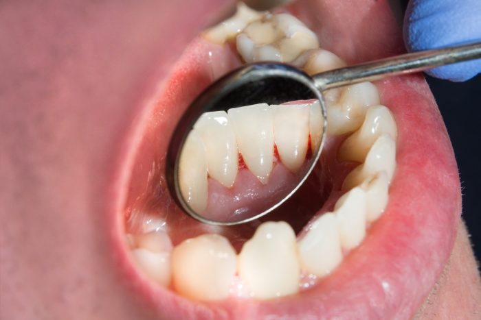 Gingivitis (Gum Disease): Causes, Risk Factors, and Symptoms