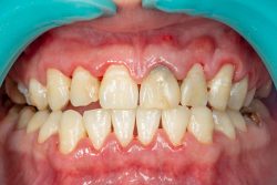 The four stages of periodontal disease | Gentle Dental Care