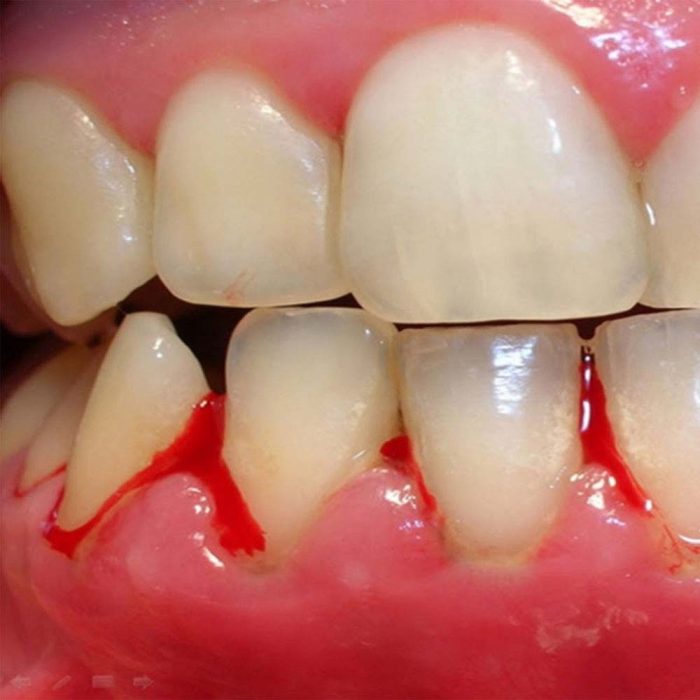 Periodontitis (Gum Disease): Symptoms, Stages & Treatment