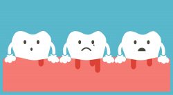 Periodontitis: Symptoms, Causes, and Treatments – What is periodontitis?