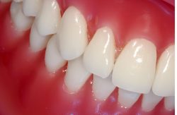 What Is A Prefabricated Post And Core In Dentistry?