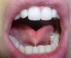 Why Is A Lingual Frenectomy Necessary?