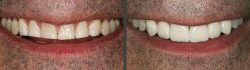 Dental Veneers Cost Houston, TX