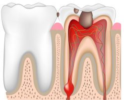 What Are Symptoms Of Abscess Tooth | Signs Of Abscess Tooth |Dental abscess symptoms & treat ...