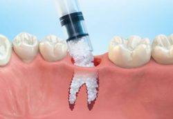 Do You Need a Bone Graft for Dental Implant?