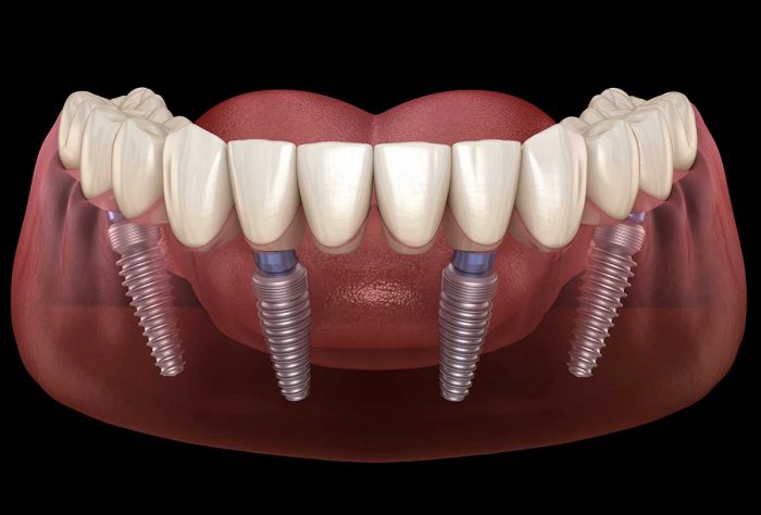 The Best Place to Get Dental Implants