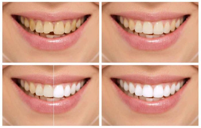 6 Month Smile Cost in Houston | Six Month Smiles – Straight Teeth in Less Time