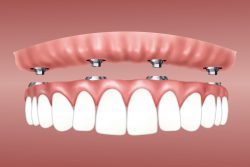 Affordable Dental Implants Near Me