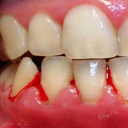 Periodontitis Treatment Houston | Stages of Periodontitis Symptoms