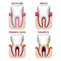 Signs of Gingivitis And Periodontitis | Periodontal Gum Disease Treatment