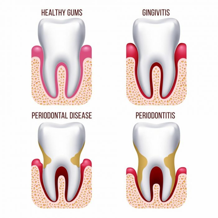Signs of Gingivitis And Periodontitis | Periodontal Gum Disease Treatment