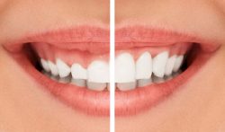 Gingivectomy Near Me | Gingivectomy Before and After