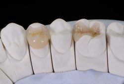 Dental Inlays Vs. Onlays: Do You Need Them?