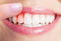 What Is A Periodontal Disease?