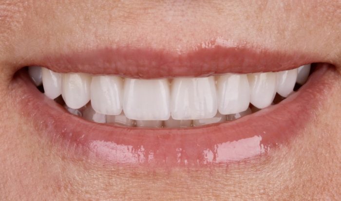 Dental Veneers vs Lumineers