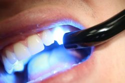 dental bonding : What Are The Benefits Of Dental Bonding?