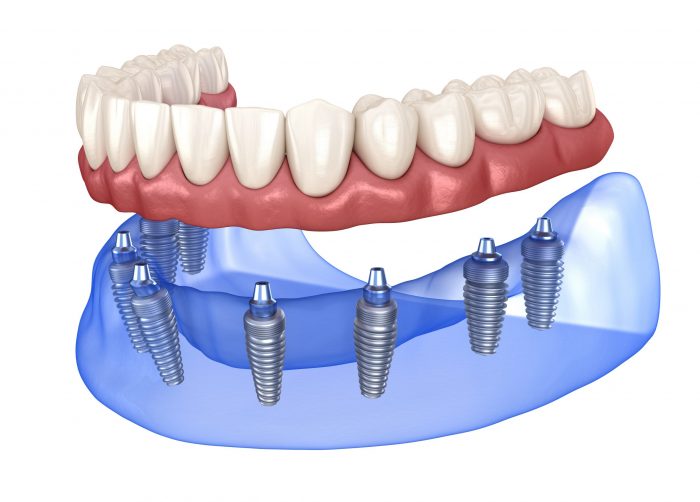 How to Replace Missing Tooth with Dental Implant?