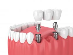 Dental Implants Cosmetic In Houston