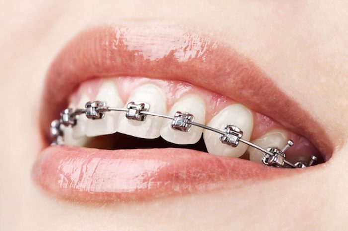 Should You Get Braces Before Dental Implants?