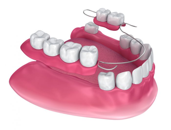 Removable Partial Dentures – Pros and Cons to Consider