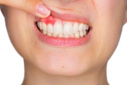 Gingivitis: What It Is, Causes, Diagnosis – Cleveland Clinic