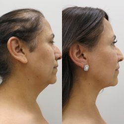 Benefits of Neck Liposuction |Benefits and Downsides of Chin Liposuction