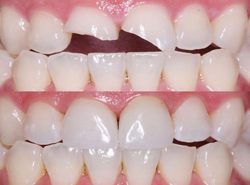 Cosmetic Dental Bonding Cost – Dental Bonding Costs (With & Without Insurance)
