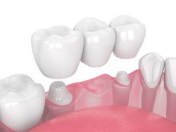 Dental Bridge Affordable Cost Houston – Cosmetic Dental Bridge Houston