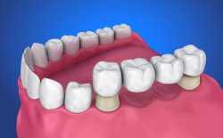 Dental Bridge in Houston, TX | Replace Missing Teeth