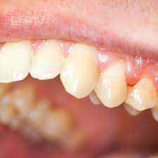 Gum Disease (Gingivitis & Periodontitis) – Causes, Symptoms, Treatment, Diagnosis