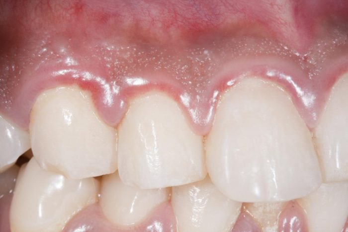 Periodontal Disease: Symptoms, Causes, & Treatment