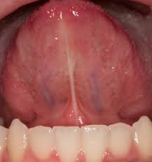 What is a Frenectomy, and Why Is It Necessary?