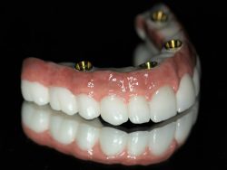 Full Mouth Dental Implants Cost – What are full mouth dental implants and what do they cost?