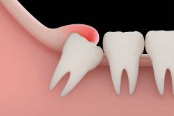 Impacted Wisdom Teeth Removal Near Me