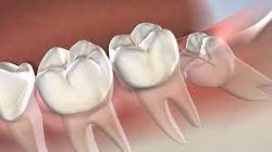Painless & Cost Effective Wisdom Teeth Removal | Wisdom Teeth Removal Clinic