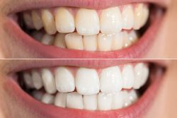 Professional Teeth Whitening Near Me |Teeth Whitening in Houston, TX