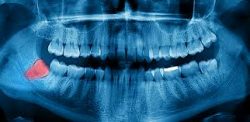 Expert Emergency Tooth Care – Best Urgent Dental Care