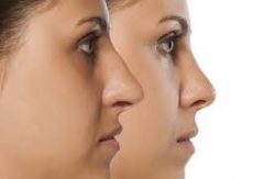 Nose Plastic Surgery Near Me | Rhinoplasty Surgery For Nose