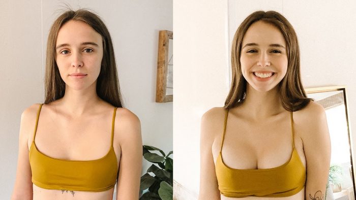 Breast Augmentation Before After |Breast Augmentation Before and After Photos